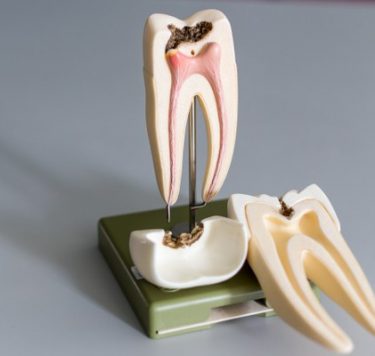 Treatment - Root Canal Treatment Milton Keynes