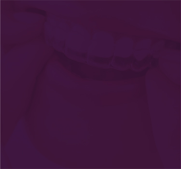 Invisalign Braces