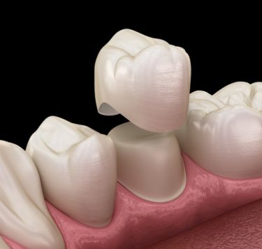 Treatment - Dental Crowns Milton Keynes