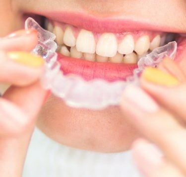 Treatment - Invisalign Milton Keynes