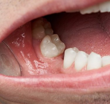 Treatment - Missing Teeth