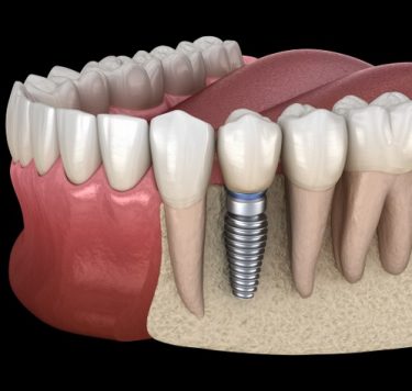 Treatment - Single Tooth Implants