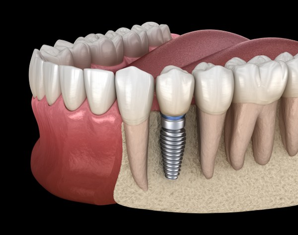 implants tooth dentures implanty stomatologiczne premolar medically hafner implantatprothetik implantologia protesi bremer bode keynes milton impianti lostineoral