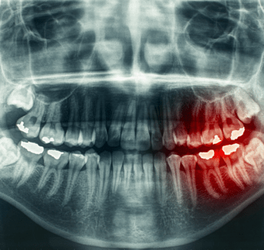 Treatment - Wisdom Teeth
