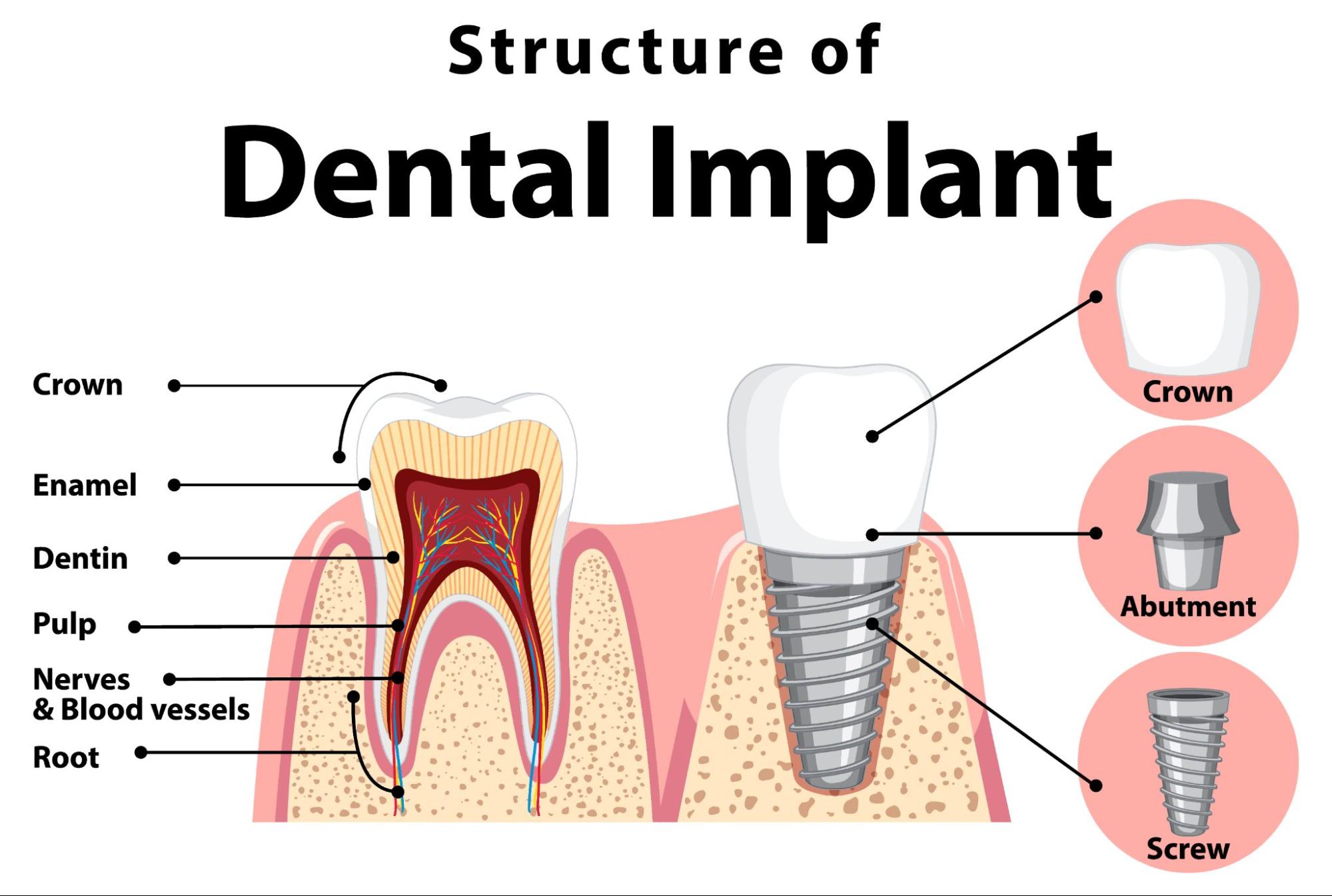 Structure if Dental Implant