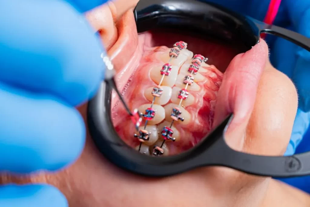 Fixed braces during an adjustment appointment as the teeth alignment progresses.