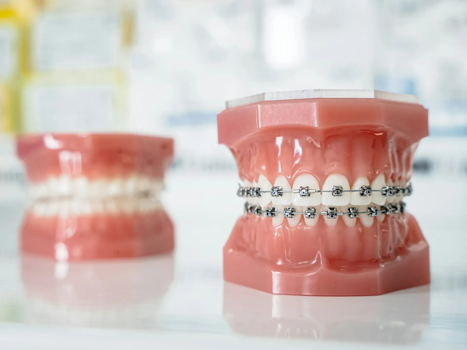 Dental model showing fixed braces on teeth.